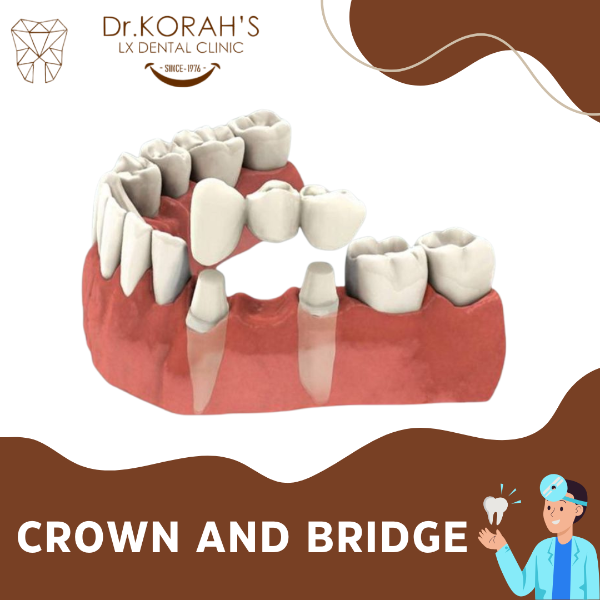 CROWN AND BRIDGE