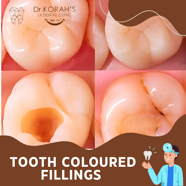 TOOTH COLOURED FILLINGS