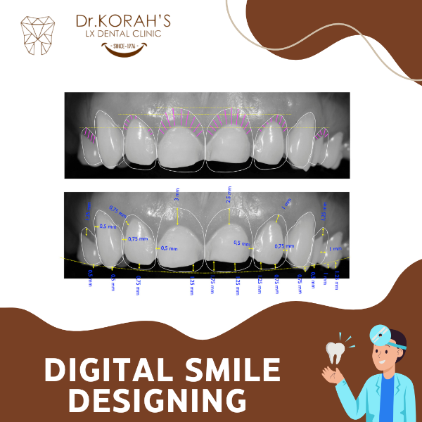 DIGITAL SMILE DESIGNING