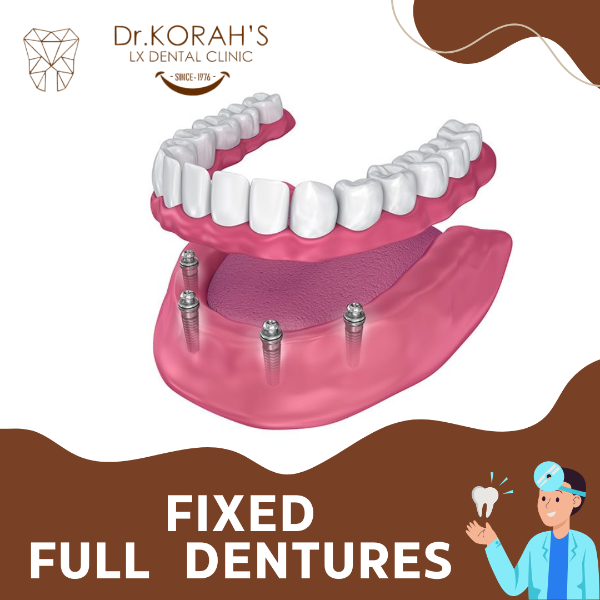 FIXED FULL DENTURES