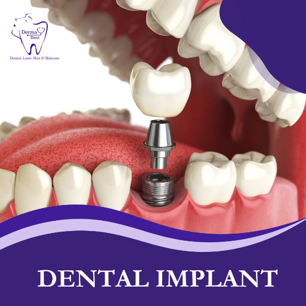 DENTAL IMPLANT