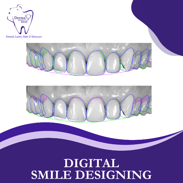 DIGITAL SMILE DESIGNING
