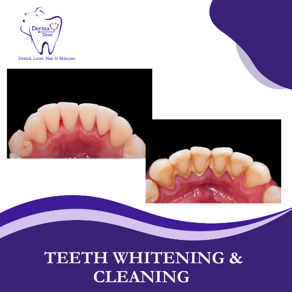 TEETH WHITENING & CLEANING