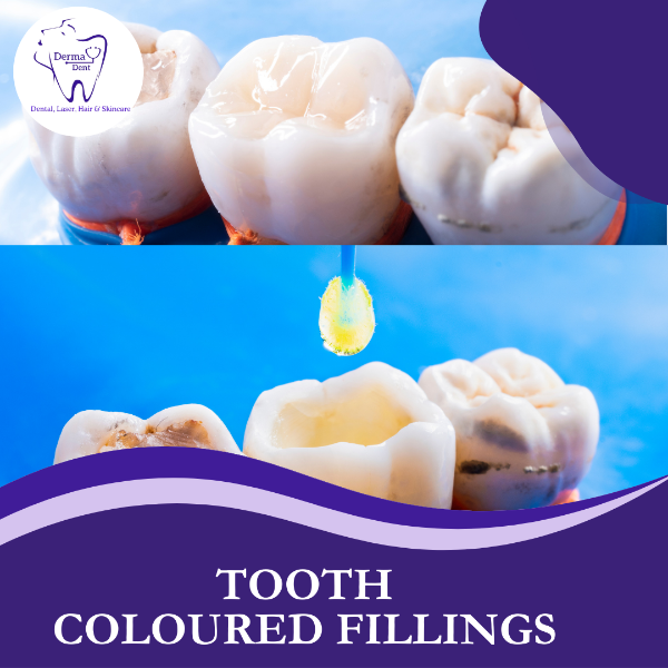 TOOTH COLOURED FILLINGS