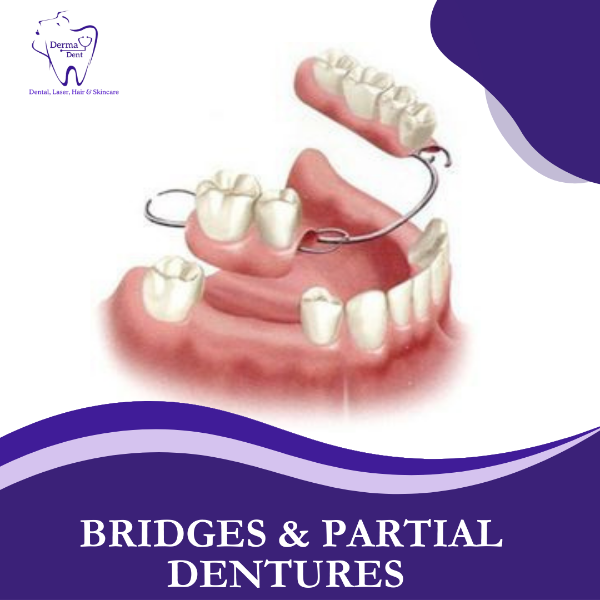 BRIDGES & PARTIAL DENTURES