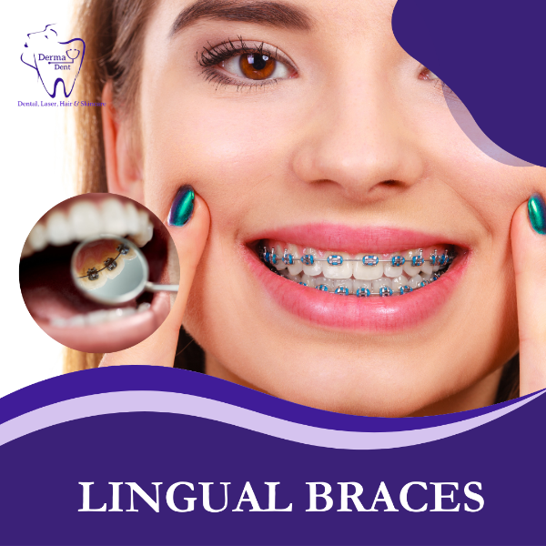 LINGUAL BRACES
