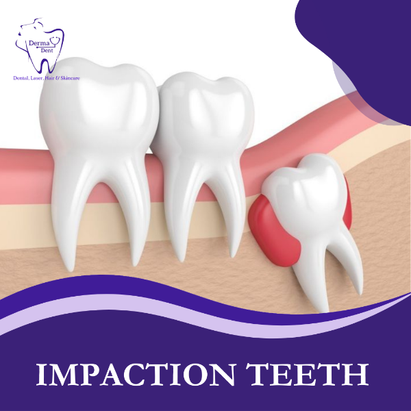 IMPACTION TEETH