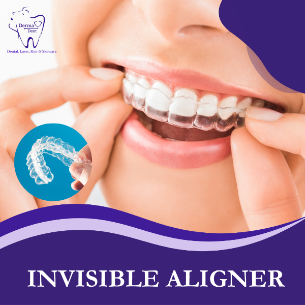 INVISIBLE ALIGNER