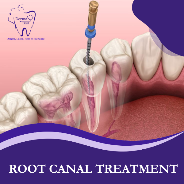 ROOT CANAL TREATMENT