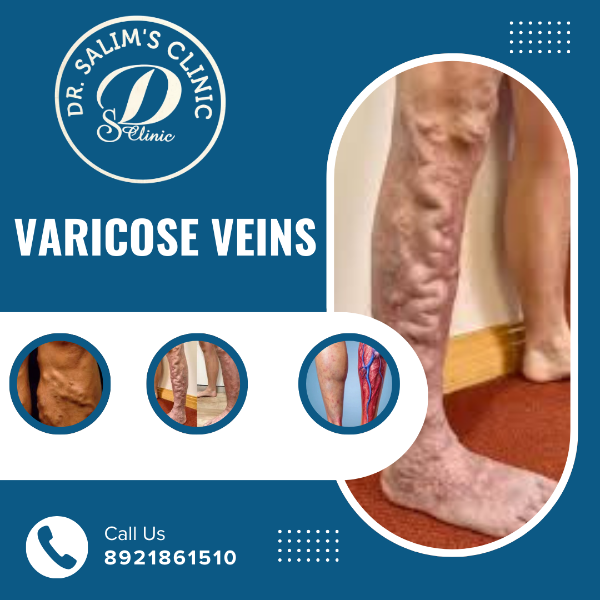 Varicose veins