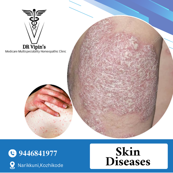 Skin Diseases