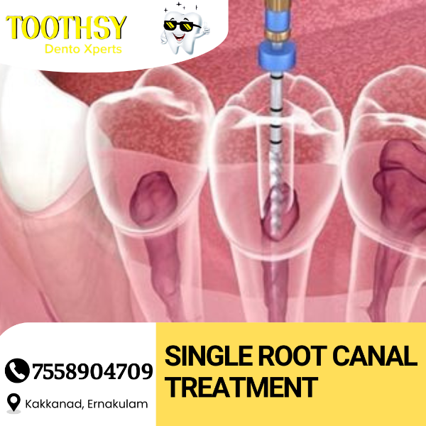 Single Root canal Treatment