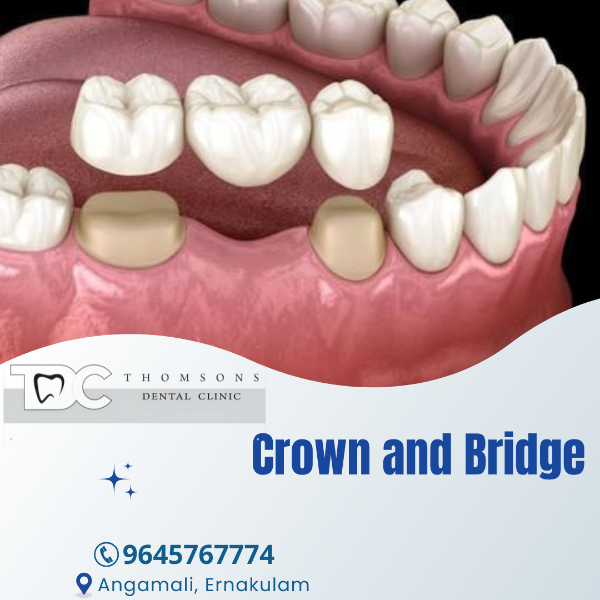 Crown and Bridge