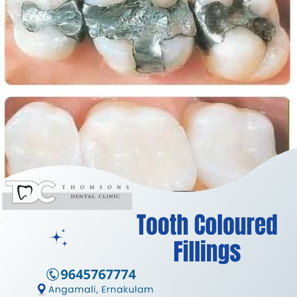 Tooth Coloured Fillings