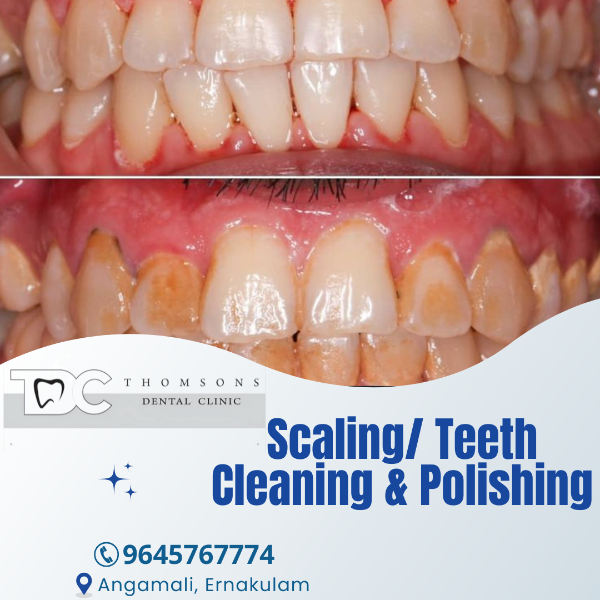Scaling/ Teeth Cleaning & Polishing