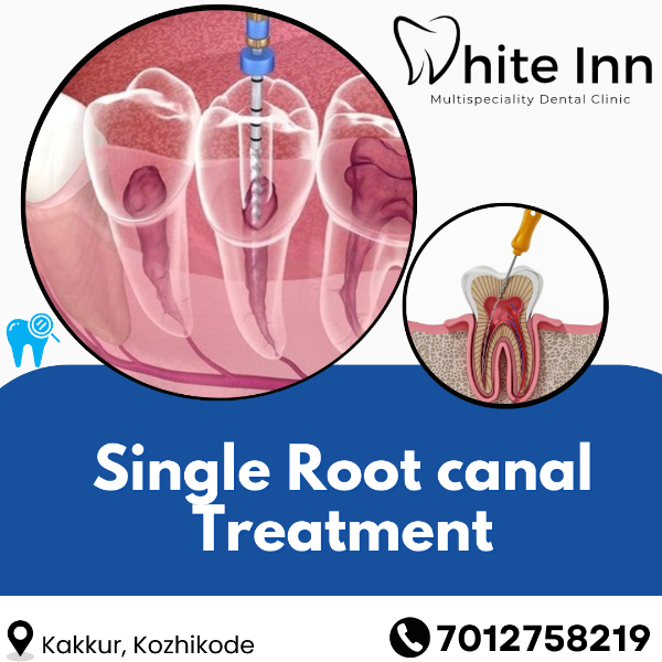 Single Root canal Treatment