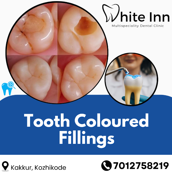 Tooth Coloured Fillings