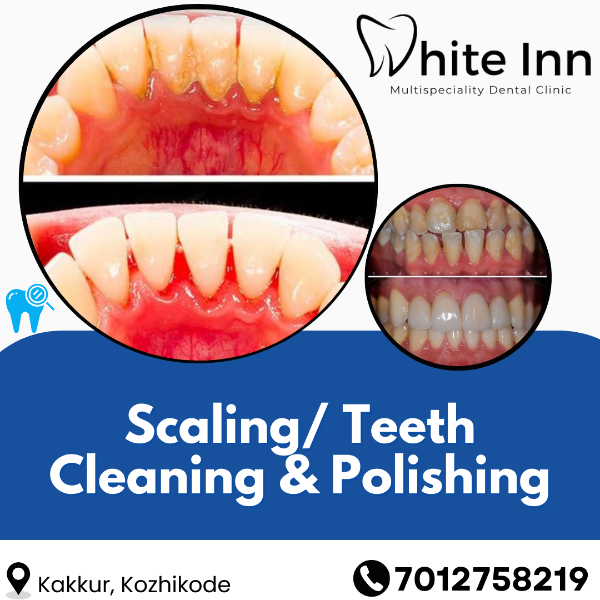 Scaling/ Teeth Cleaning & Polishing
