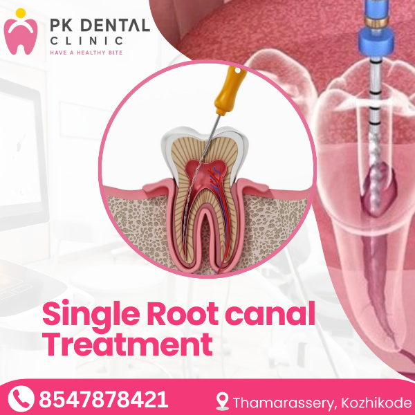 Single Root canal Treatment