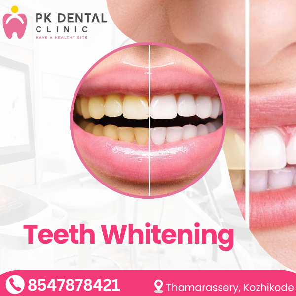 Teeth Whitening