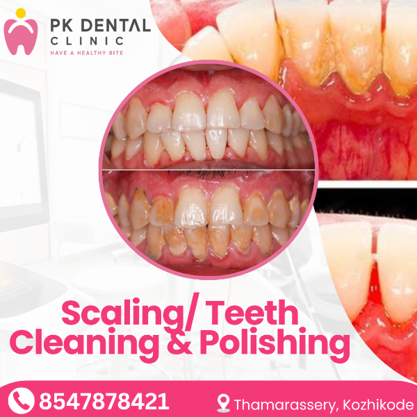 Scaling/ Teeth Cleaning & Polishing
