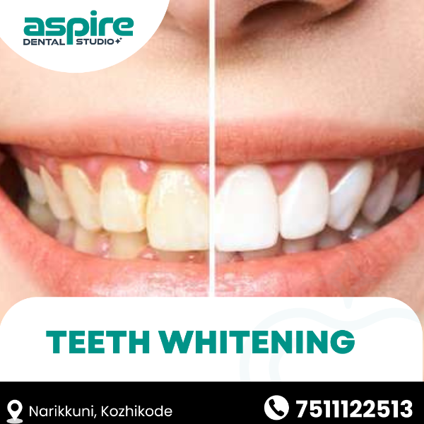 Teeth Whitening
