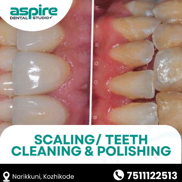 Scaling/ Teeth Cleaning & Polishing