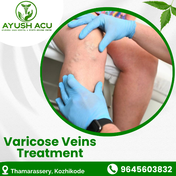 Varicose Veins Treatment