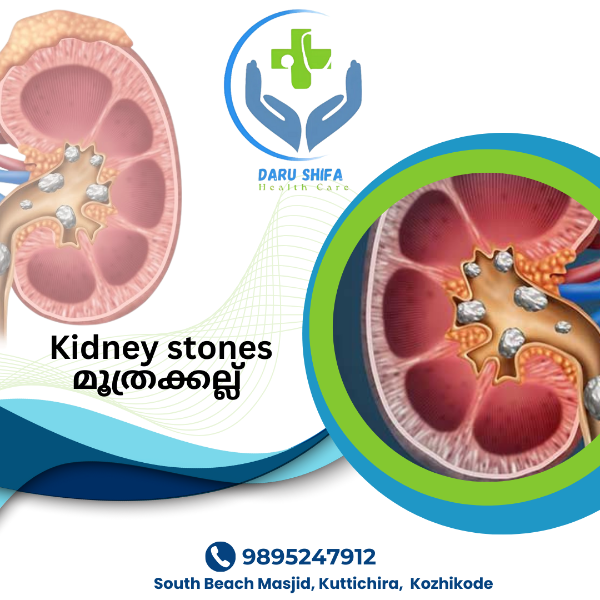 മൂത്രക്കല്ല്
