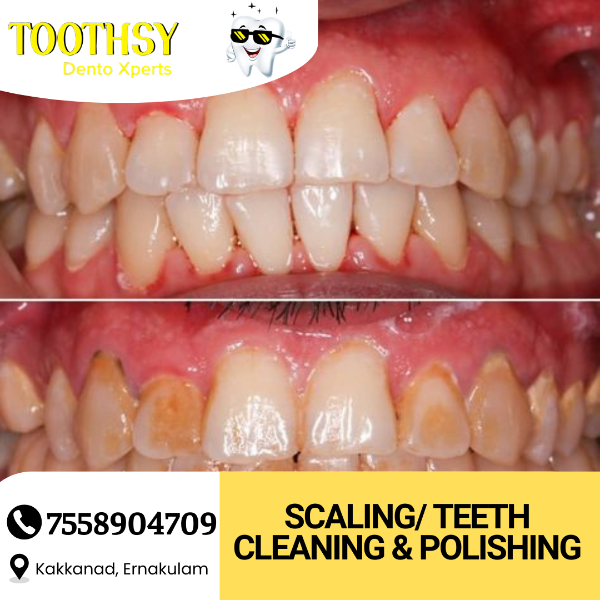Scaling/ Teeth Cleaning & Polishing