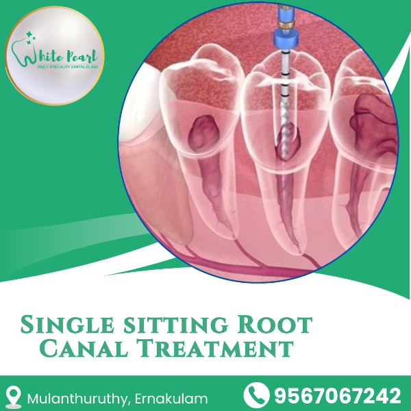 Single sitting Root Canal Treatment