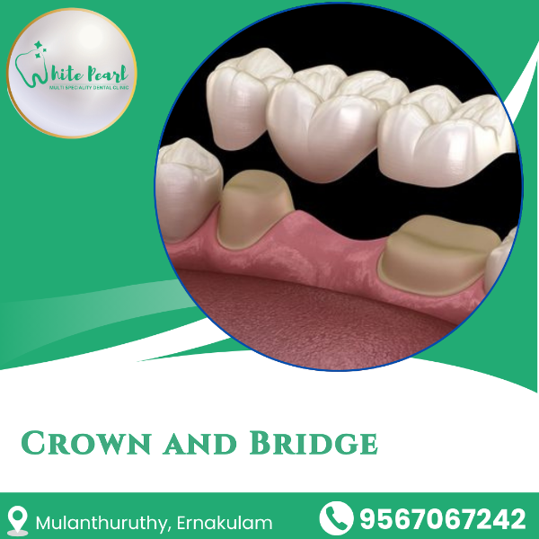 Crown and Bridge