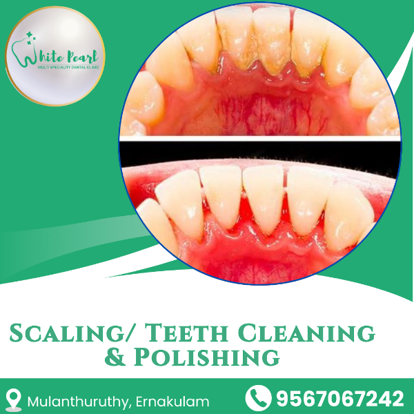 Scaling/ Teeth Cleaning & Polishing