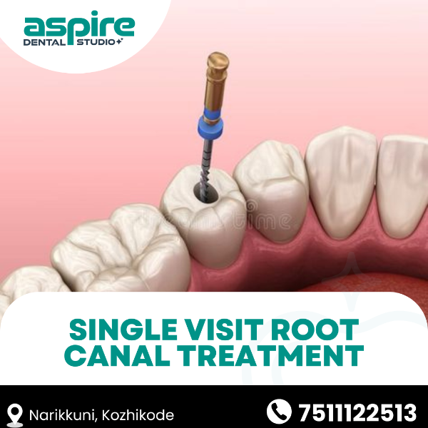 Single visit root canal treatment