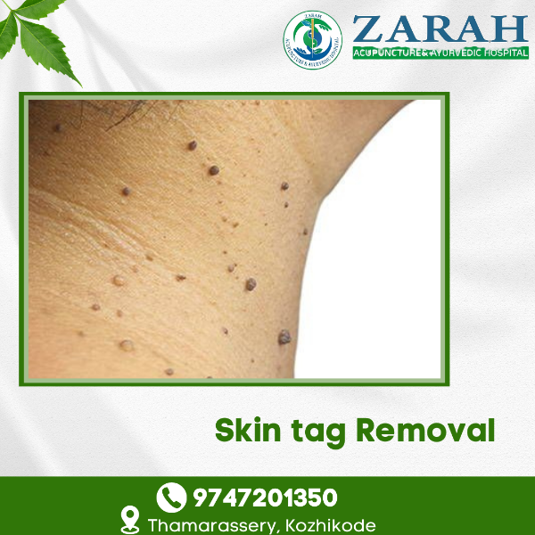 Skin tag Removal