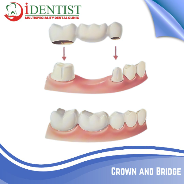 Crown and Bridge