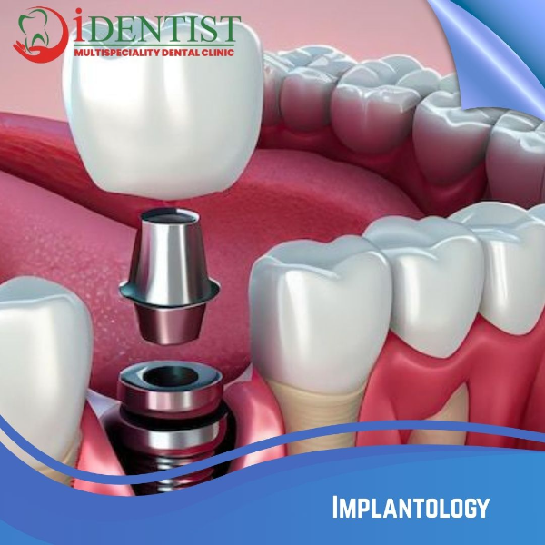 Implantology