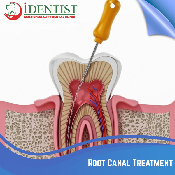 Root Canal Treatment