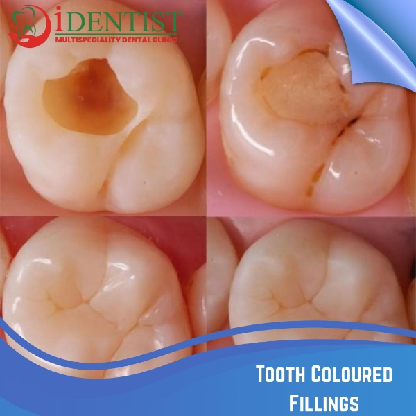 Tooth Coloured Fillings