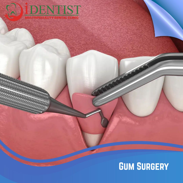 Gum Surgery