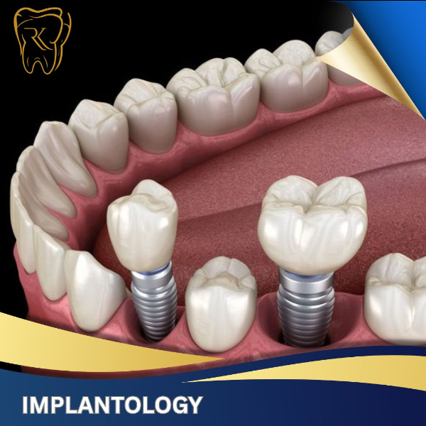 Implantology