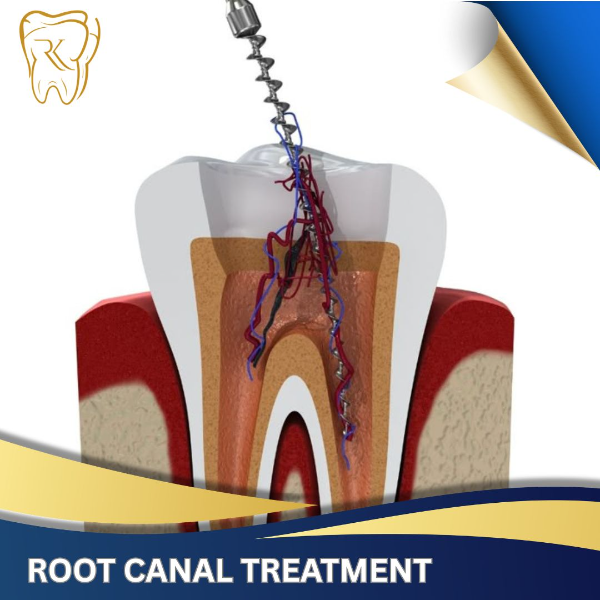 Root Canal Treatment