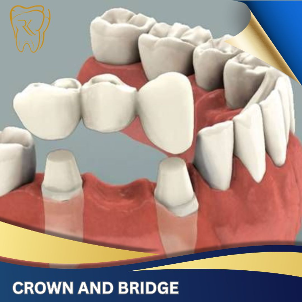 Crown And Bridge