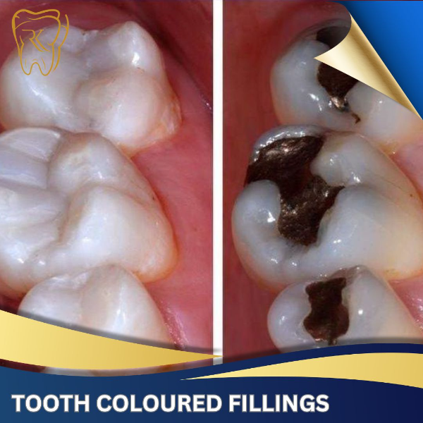 Tooth Coloured Fillings
