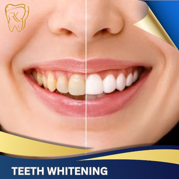 Teeth Whitening