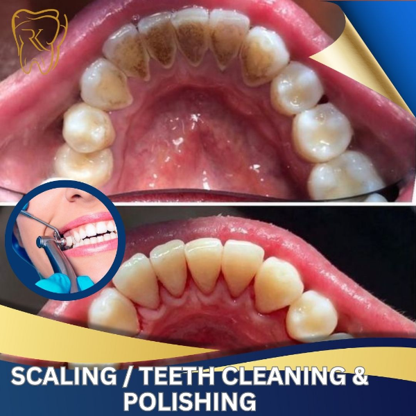 Scaling / Teeth Cleaning & Polishing
