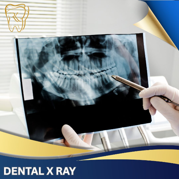 Dental X Ray