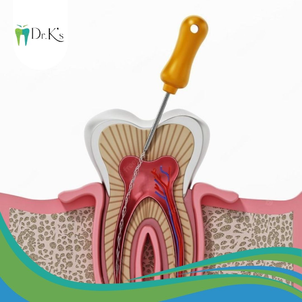 Root Canal Treatment