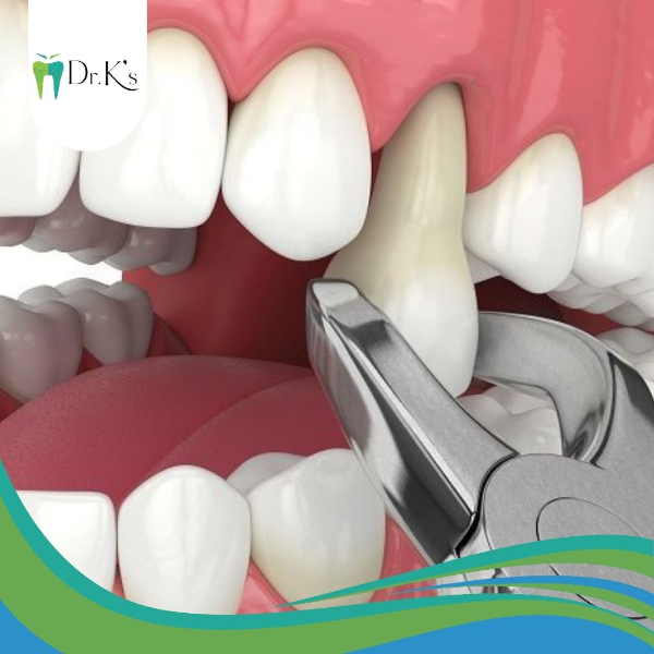 surgical vs non surgical tooth extraction