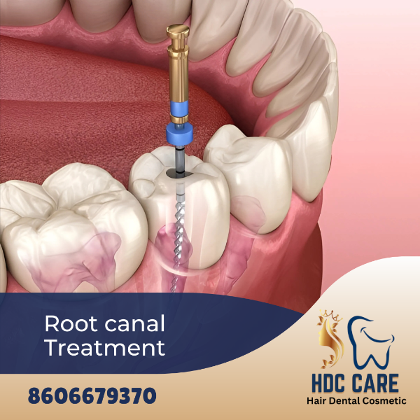 Root canal Treatment